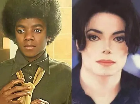 Michael Jackson Did Not Bleach His Skin to Appear White – Vitiligo