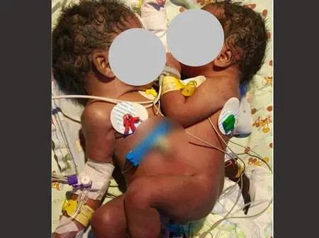 KNH successfully separates conjoined twins in rare surgery to divide shared intestine