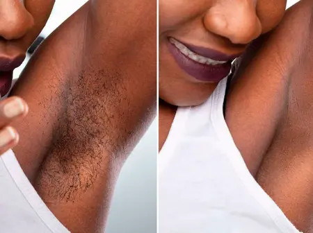 Going bald? Here’s why that hair-removal cream or wax could give you more than you bargained for